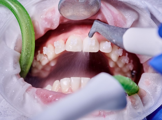 Foto médico que hace limpieza dental profesional en una clínica dental