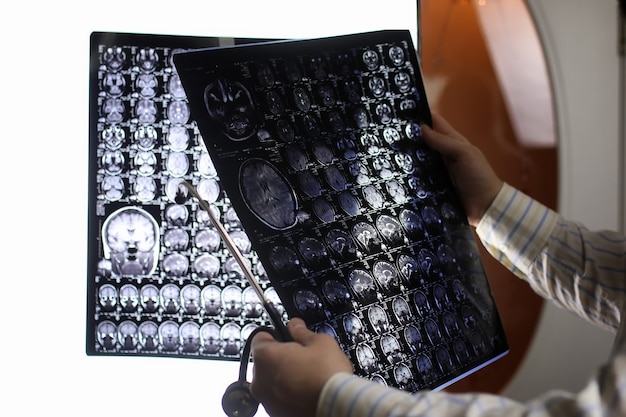 Médico segurando uma foto de um fluxo de trabalho de ressonância magnética do cérebro em um hospital de diagnóstico