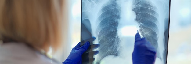 Foto el médico sostiene la radiografía en el concepto de diagnóstico hospitalario de neumonía covid y bronquitis