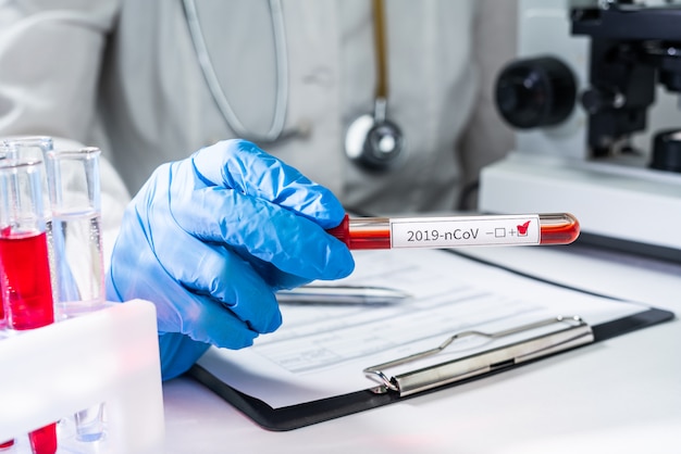 Un médico sostiene en su mano un tubo de ensayo con un análisis de sangre positivo para el nuevo coronavirus 2019-nCoV de China.