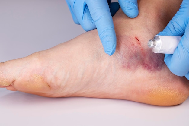 Médicos com luvas esfregam pomada medicinal para ferir a perna do paciente