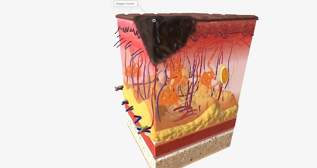 Melanoma lentiginoso acral em estágio II ALM