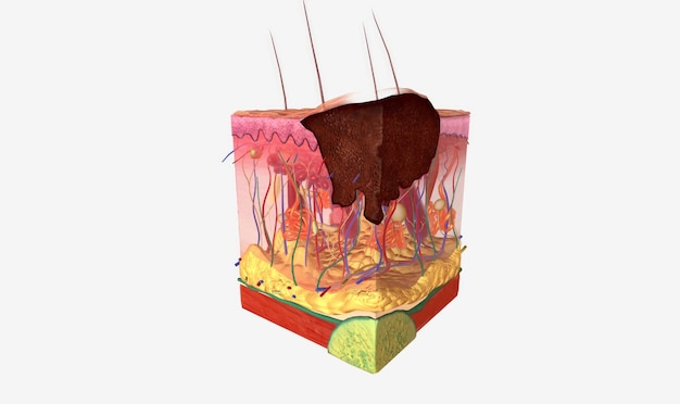 Melanomtumoren im Stadium I haben sich von der Epidermis in die Dermis ausgebreitet