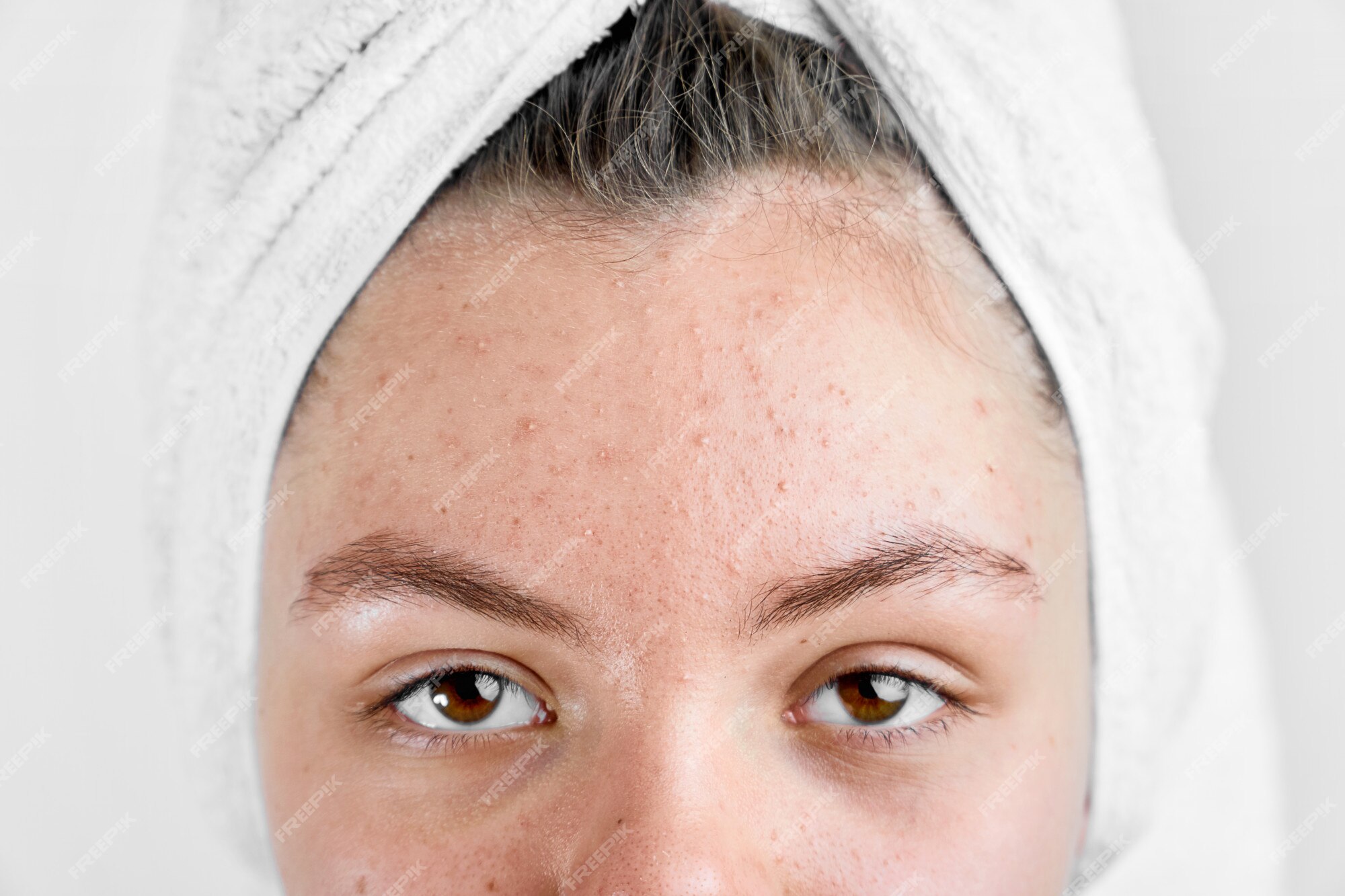 Menina De Scowling Que Aponta Para Sua Acne Com Uma Toalha Em Sua Cabeça.  Conceito Do Cuidado Da Pele Da Mulher, Fotos Da Menina Feia Da Pele Do  Problema No Fundo Branco