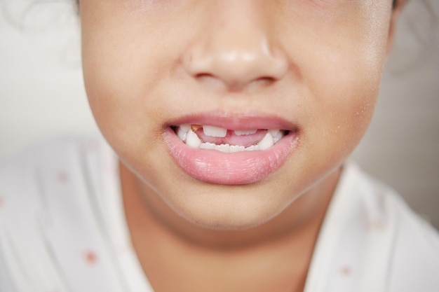 Menina criança com dentes deformados