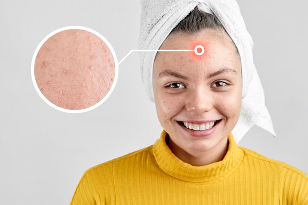 Menina depois de spa em toalha branca com problema de acne pele problema de período de puberdade