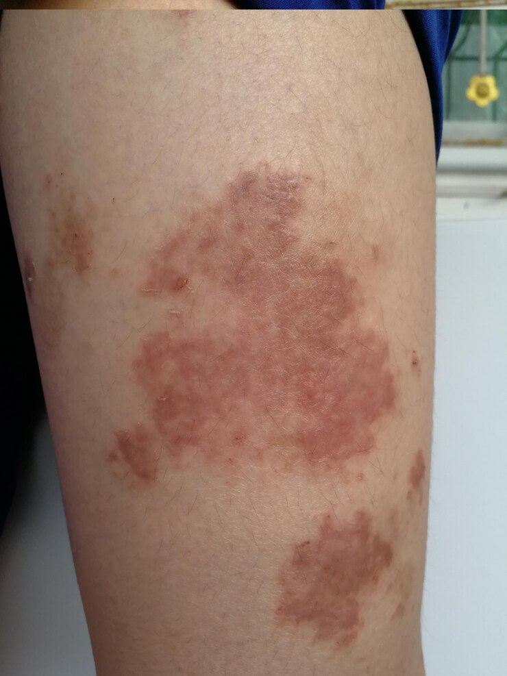 Foto menino com erupção cutânea crónica doença cutânea alérgica à erva dermatite atópica manchas cutâneas por idade
