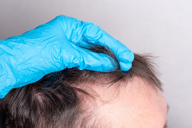 Menschliche Kahlheit oder Haarausfall nach Coronavirus - ein Arzt in blauen medizinischen Handschuhen untersucht das Haar und die Kopfhaut eines Mannes, Nahaufnahme. Konzept der menschlichen Alopezie. Problem mit Haarausfall