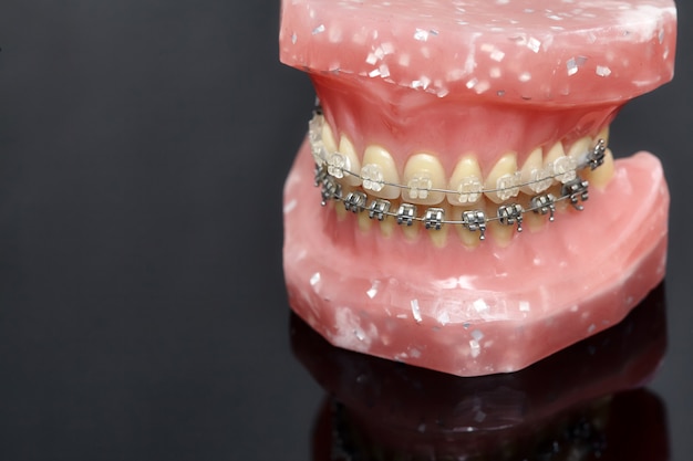 Menschliches Kiefer- oder Zahnmodell mit metallverdrahteten Zahnspangen