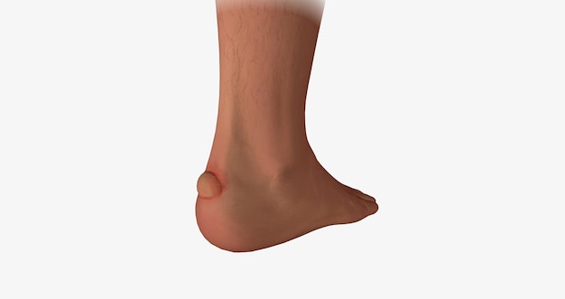A menudo se forman ampollas en los talones de los pies y en las superficies internas de agarre de las manos.