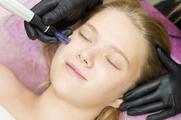 Mesoterapia con agujas. La cosmetóloga realiza mesoterapia con agujas en la cara de una mujer. Hermosa mujer recibiendo tratamiento de rejuvenecimiento con microagujas. Levantamiento de agujas