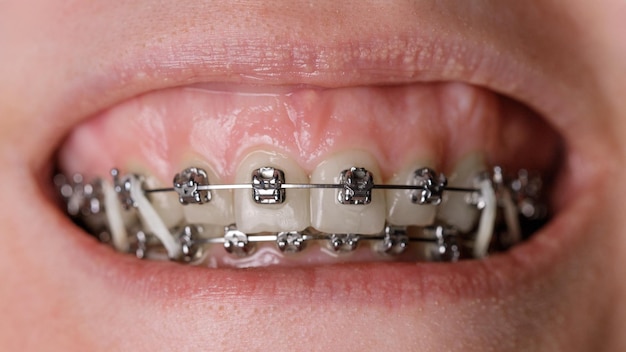 Foto metallorthodontische klammern auf schiefen zähnen nahaufnahme gummy-lächeln