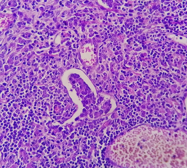 Microfotografía de adenocarcinoma de estómago. Adenocarcinoma gástrico.