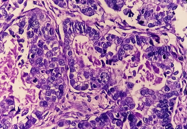 Microfotografía de adenocarcinoma de estómago o cáncer de estómago