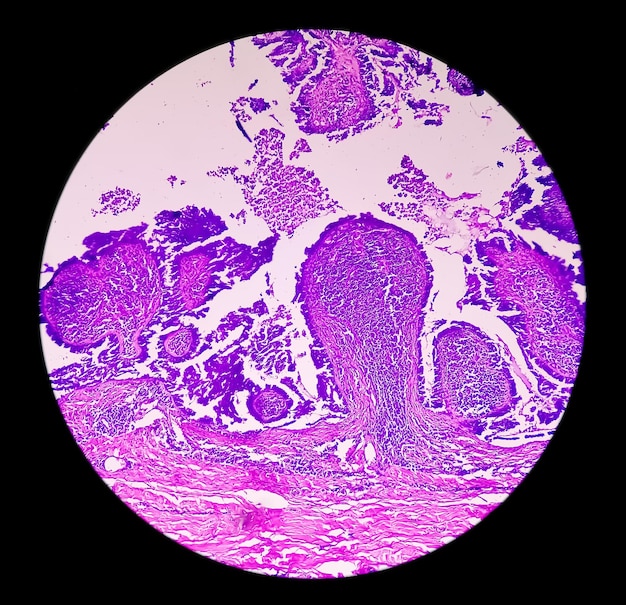 Foto microfotografía de carcinoma endometrial o cáncer para el concepto de concienciación sobre el cáncer endometrial