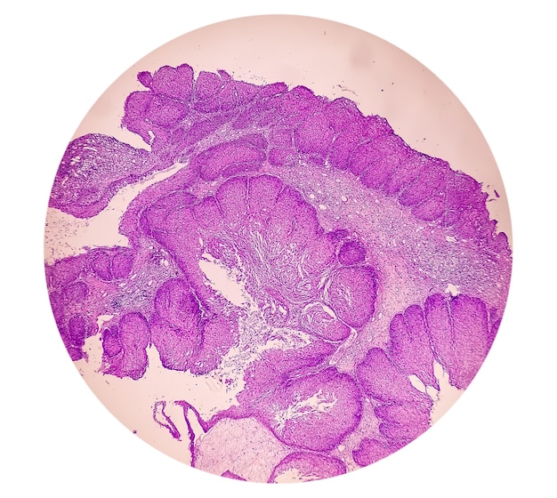 Microfotografía de un papiloma invertido sinonasal o SNIP