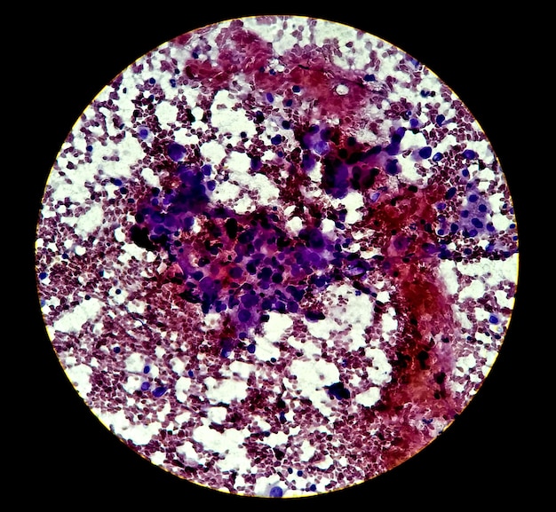 Microfotografía que muestra adenocarcinoma de vesícula biliar. cáncer de vesícula biliar. prueba fnac, laboratorio de histología