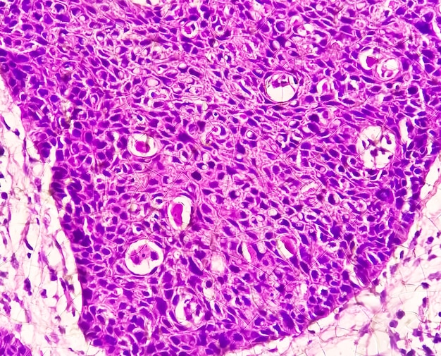 Microfotografía que muestra el carcinoma de células escamosas de la lengua de grado II. SCC oral invasivo.