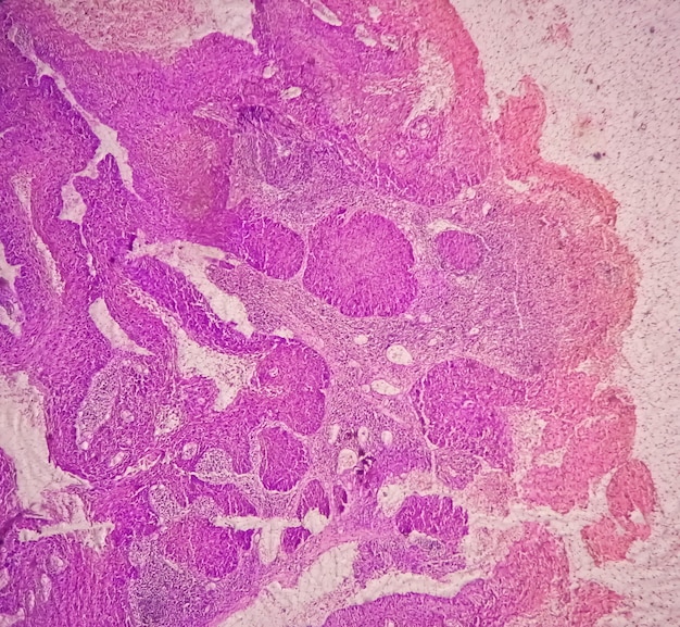 Foto microfotografía que muestra el carcinoma de células escamosas de la lengua de grado ii. scc oral invasivo.