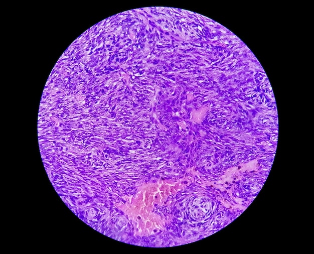 Foto microfotografía de schwannoma un tumor benigno de tejidos blandos de la vaina del nervio periférico