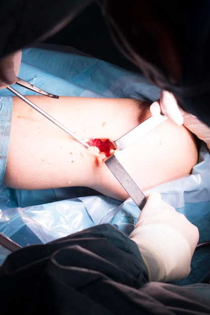 Foto midsection von chirurgen, die in einem krankenhaus eine knieoperation durchführen