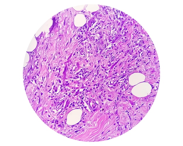 Mikrophotographie der granulomatösen Gewebehistologie, die ein Fremdkörpergranulom zeigt