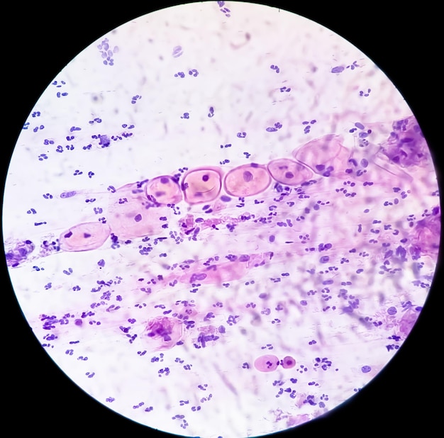Mikrophotographie eines Pap-Abstrichs Entzündlicher Abstrich mit HPV-bedingten Veränderungen Gebärmutterhalskrebs SCC