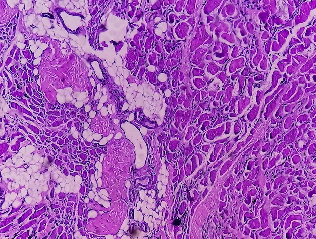 Mikroskopische Ansicht einer histologischen Gewebestudie, die ein Rhabdomyom zeigt