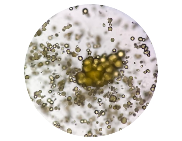 Mikroskopisches Bild der Urinanalyse. Abnormale Urinuntersuchung. Harnsäurekristalle.