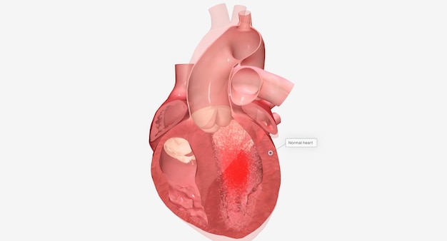 La miocardiopatía es una enfermedad del músculo cardíaco que provoca la