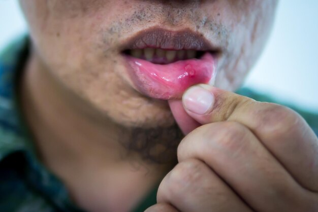 Foto mittelabschnitt eines mannes mit mundgeschwür