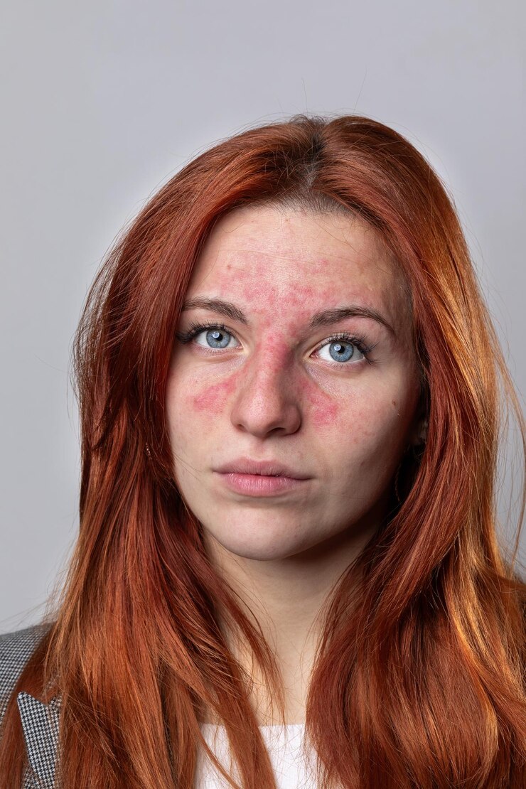 Foto modelo caucasiano que sofre de rosácea facial