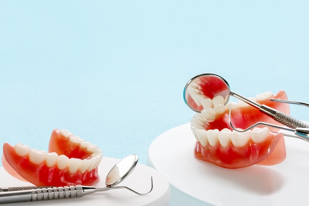 Modelo de dentes mostrando um modelo de ponte coroa de implante