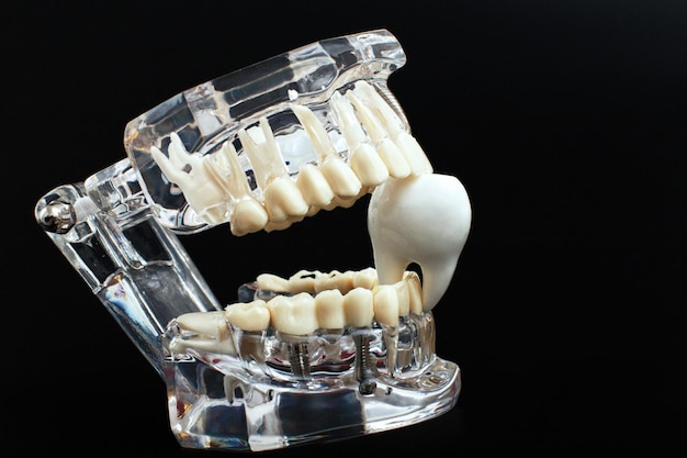 Modelo de mandíbula dentária sobre fundo preto Alinhadores ou aparelhos dentários invisíveis transparentes aplicáveis a um tratamento dentário ortodôntico