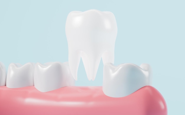Modelo de diente humano Implantación de dientes Ortodoncia renderización en 3D