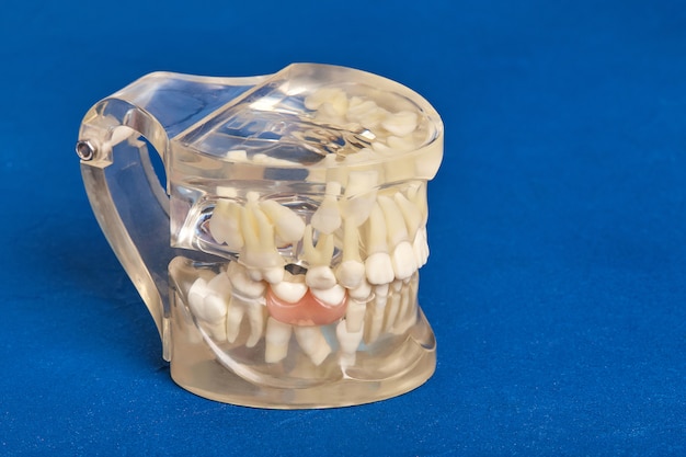 Modelo de dientes humanos con implantes