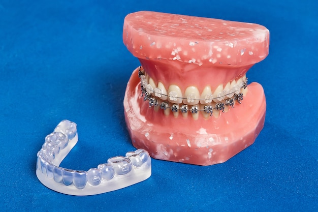 Modelo humano de mandíbula ou dentes com aparelho dental com fio de metal