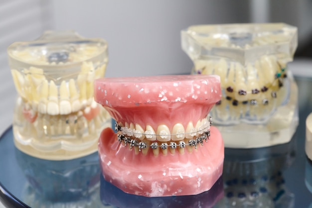 Modelo humano de mandíbula ou dentes com aparelho dental com fio de metal