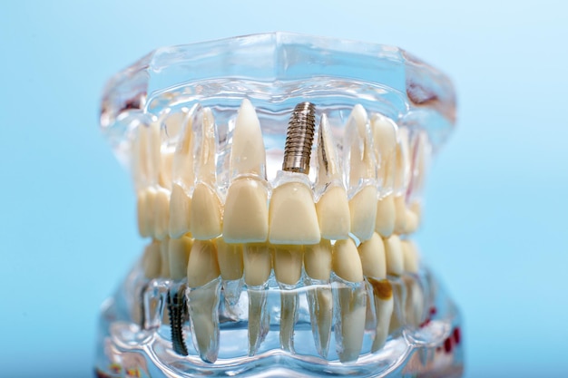 Modelo de mandíbula dental sobre fondo azul Dentista dientes protésicos encías raíces primer plano