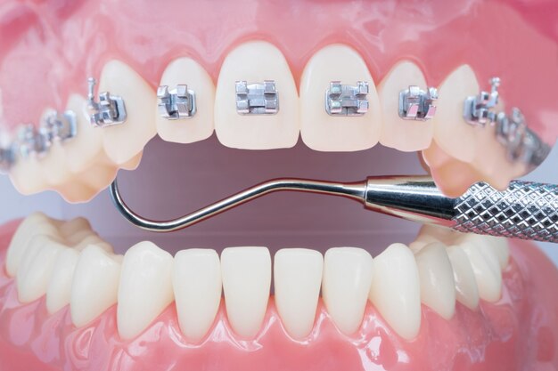 Foto modelo de ortodoncia y herramienta de dentista: modelo de demostración de dientes de diversas variedades de brackets o brackets de ortodoncia