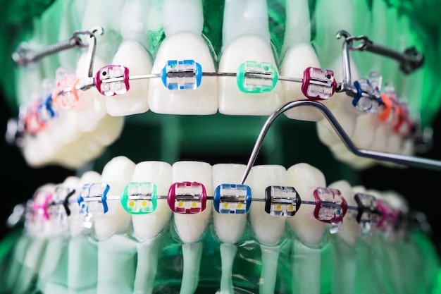 Modelo de ortodoncia y herramienta de dentista: modelo de demostración de dientes de diversas variedades de brackets o brackets de ortodoncia