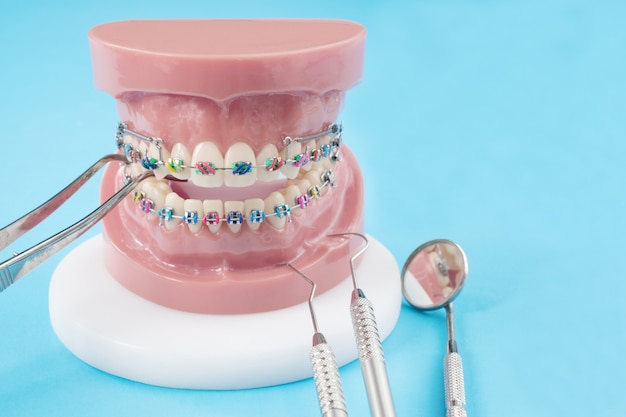 Modelo de ortodoncia y herramienta de dentista: modelo de demostración de dientes de variedades de brackets o brackets de ortodoncia