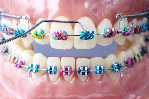 Modelo de ortodoncia y herramienta de dentista. Modelo de demostración de dientes de variedades de ortodoncia.