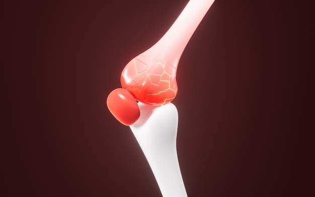 Modelo de rótula humana artroflogosis hinchazón de las articulaciones dolor de las juntas conceptos biológicos y médicos renderización 3D