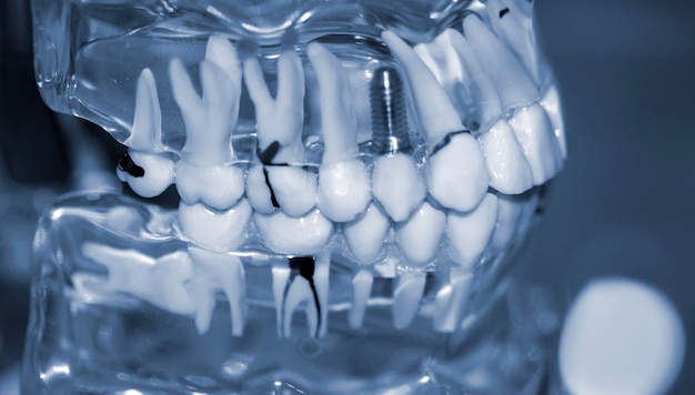 Modelo transparente de dientes humanos con implantes de cerca