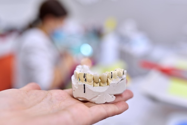 Modelo de yeso de dientes de mandíbula con coronas de cerámica, fondo de consultorio de dentista, concepto de ortopedia, prótesis, odontología