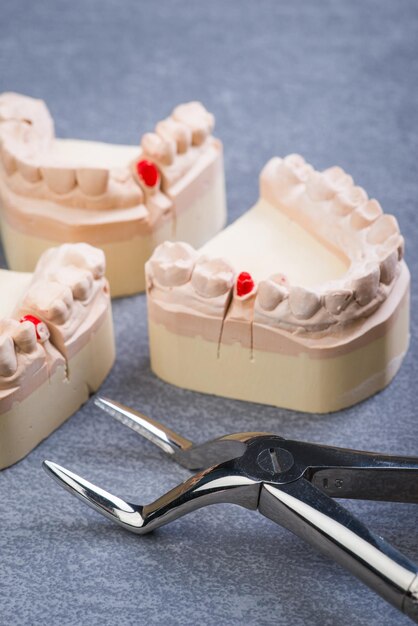 Foto molde de dientes con fórceps dental