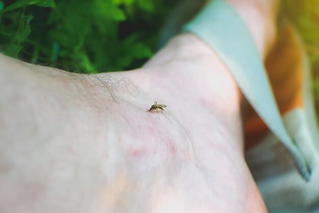 Moskito sitzt auf dem Bein Insektenstich im Sommer Gefährliche Natur Juckender Körper