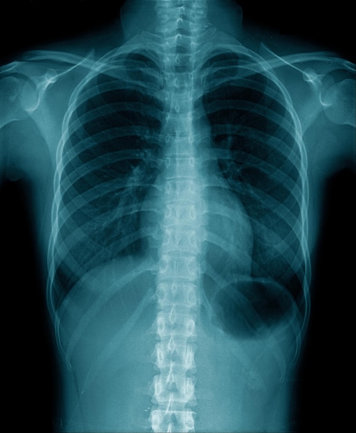 Mostra de raio X do tórax da imagem do raio X humano dentro do pulmão