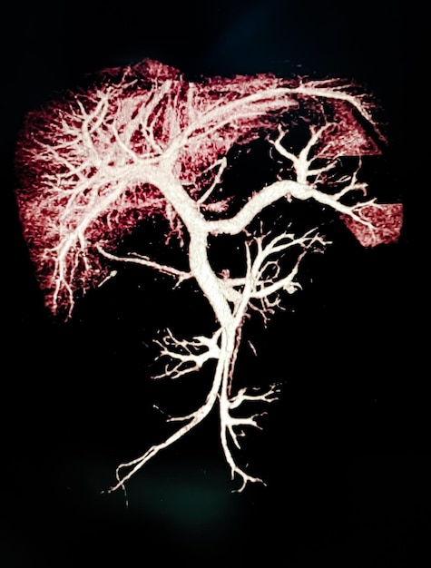 MRCP 3D MIP vista que muestra visualizar los conductos hepato-biliares y pancreáticos Ilustración 3D